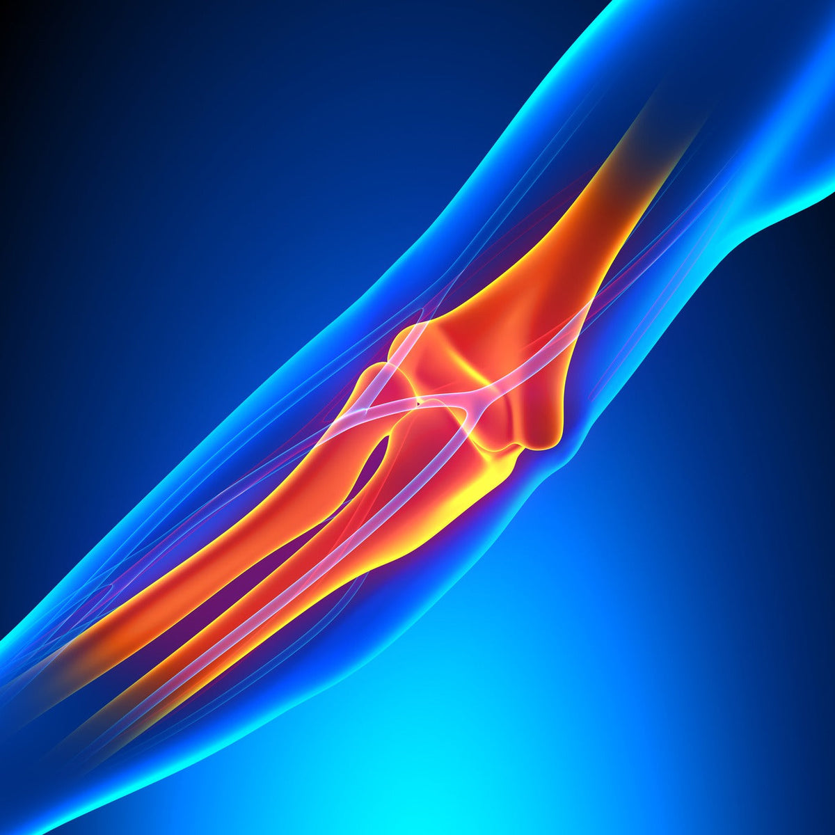 Tennis Elbow